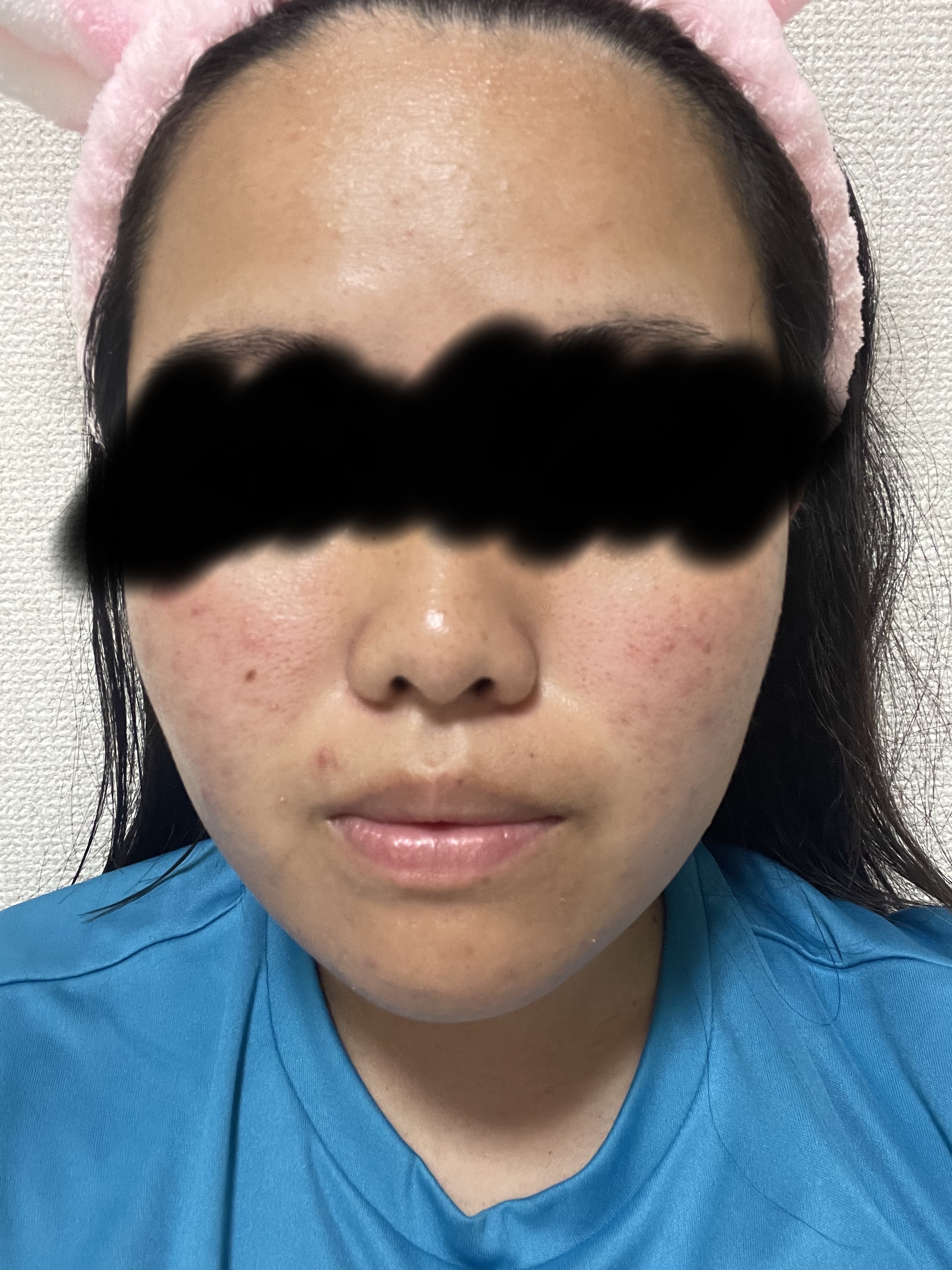 薬用 極潤 スキンコンディショナー/肌ラボ/化粧水を使ったクチコミ（2枚目）