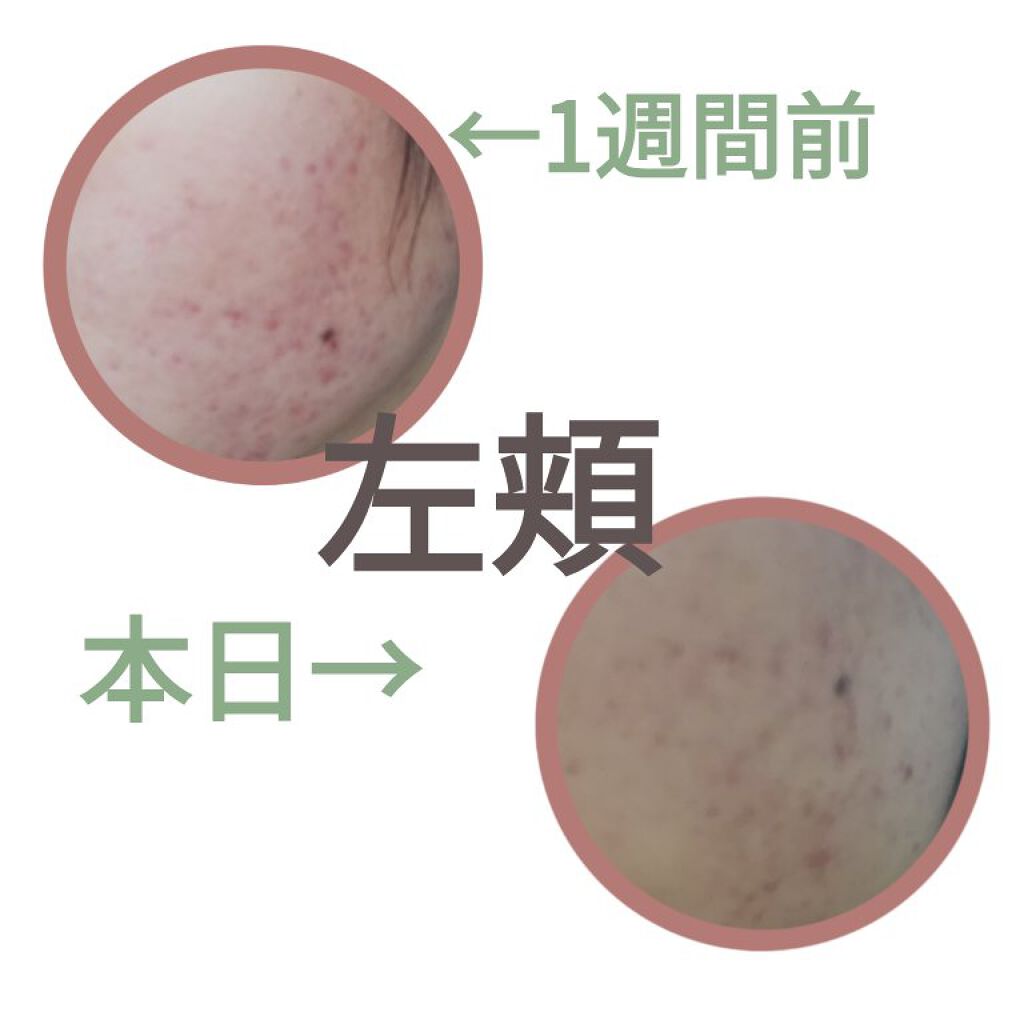 アポスティークリーム(医薬品)/アポスティー/その他を使ったクチコミ（3枚目）