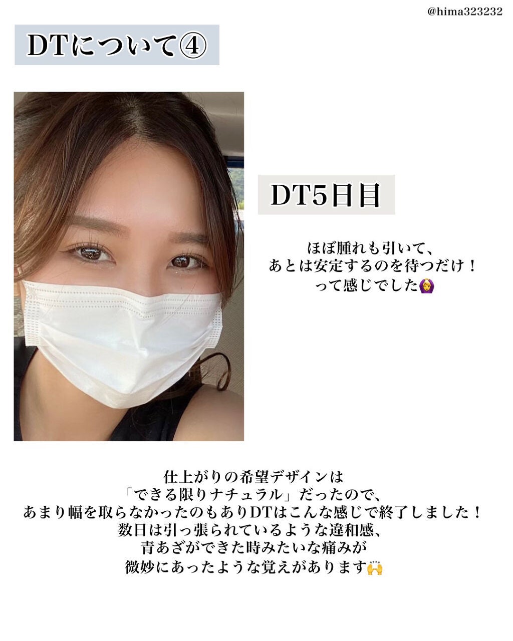 ひまちゃん /垢抜けの参考書 on LIPS 「【整形】〜私が施術した二重埋没について〜本日は!1年半くらい前..」(7枚目)