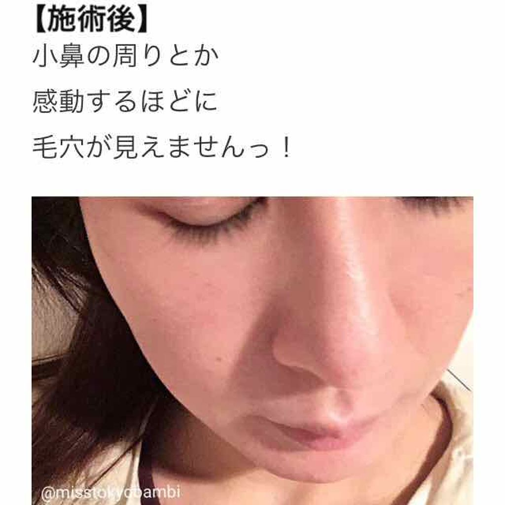 ハイドラフェイシャル/その他を使ったクチコミ（2枚目）