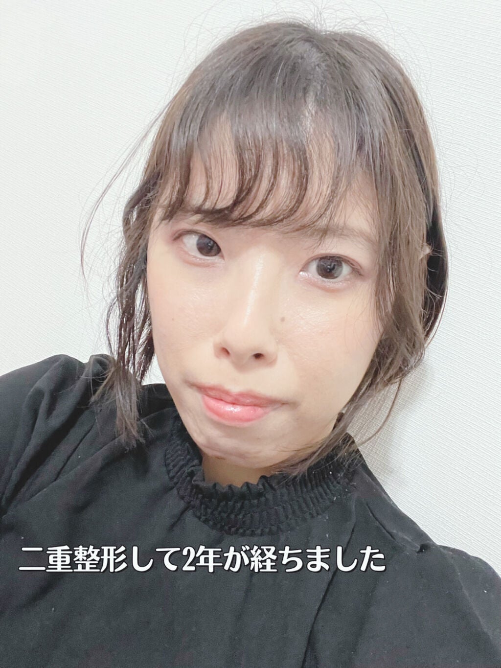 しおり on LIPS 「二重整形について〜私は2年前に二重整形、埋没をしました学生の頃..」(1枚目)