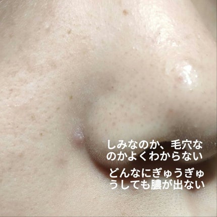 AI on LIPS 「!!!写真観覧注意!!!そのニキビ、ニキビではないかもしれない..」(2枚目)