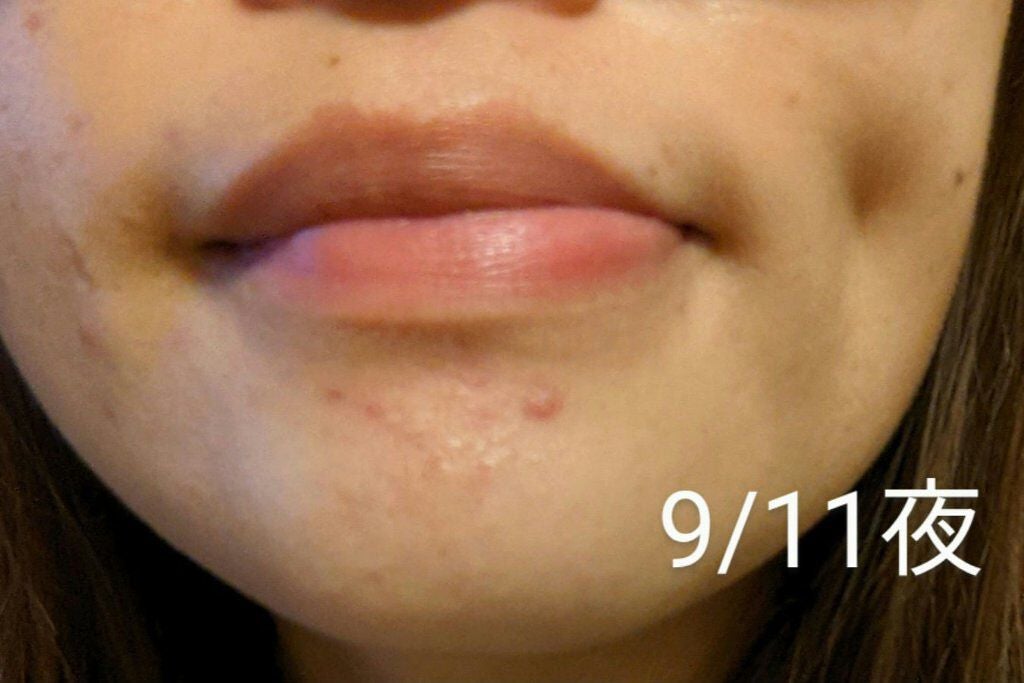 チョコラBBプラス (医薬品)/チョコラBB/その他を使ったクチコミ(4枚目)