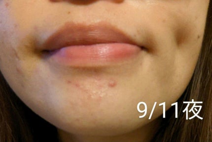 チョコラBBプラス (医薬品)/チョコラBB/その他を使ったクチコミ(4枚目)