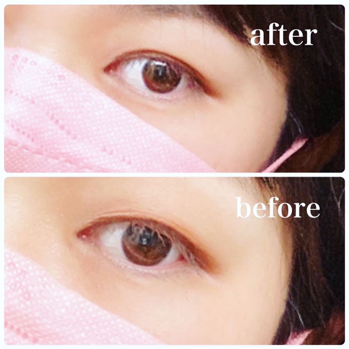 湘南美容アイリッドグルー/湘南美容/二重まぶた用アイテムを使ったクチコミ(5枚目)