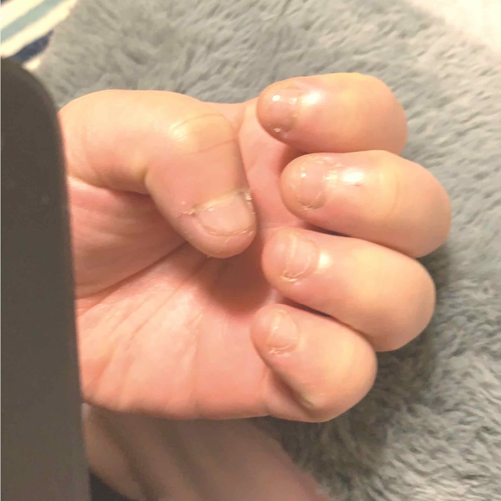 たんれい@脱爪噛み on LIPS 「そろそろ噛みたくなってきた!と思い始めたので、投稿しておこうと..」(3枚目)