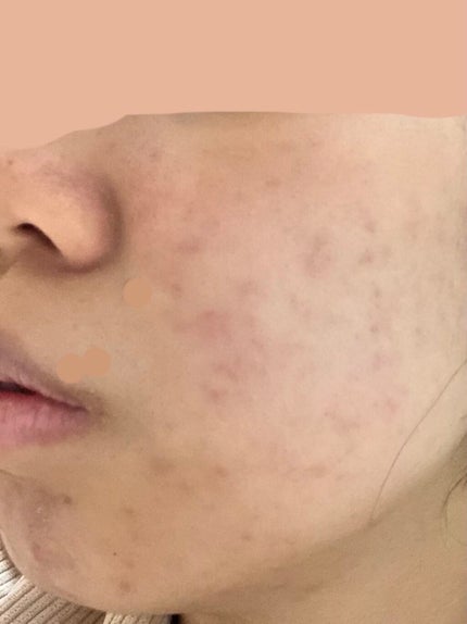 薬用しみ対策 美白化粧水/メラノCC/化粧水を使ったクチコミ(1枚目)