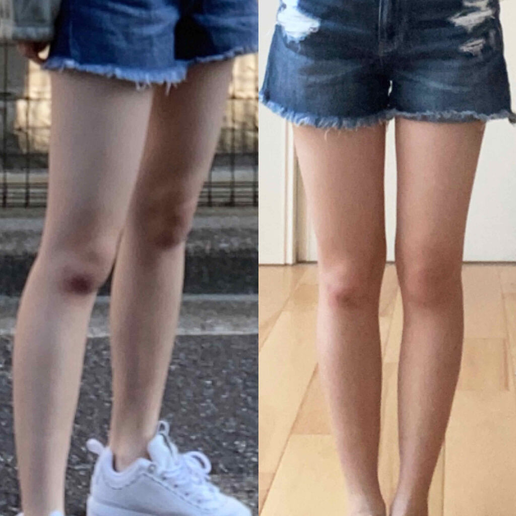 寝ながらメディキュット スパッツ 骨盤テーピング/メディキュット/着圧ソックス・レギンスを使ったクチコミ（2枚目）