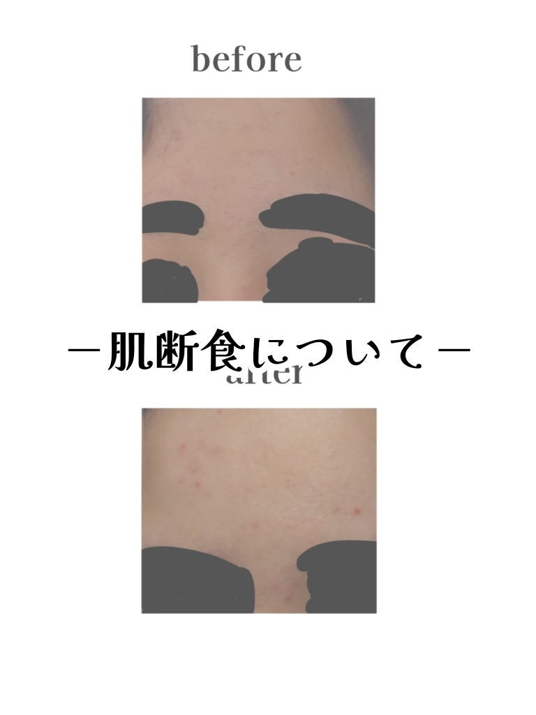 こゆき on LIPS 「❤︎肌断食について❤︎ニキビが気になっていたので、𝙔𝙤𝙪𝙩𝙪𝙗..」(1枚目)