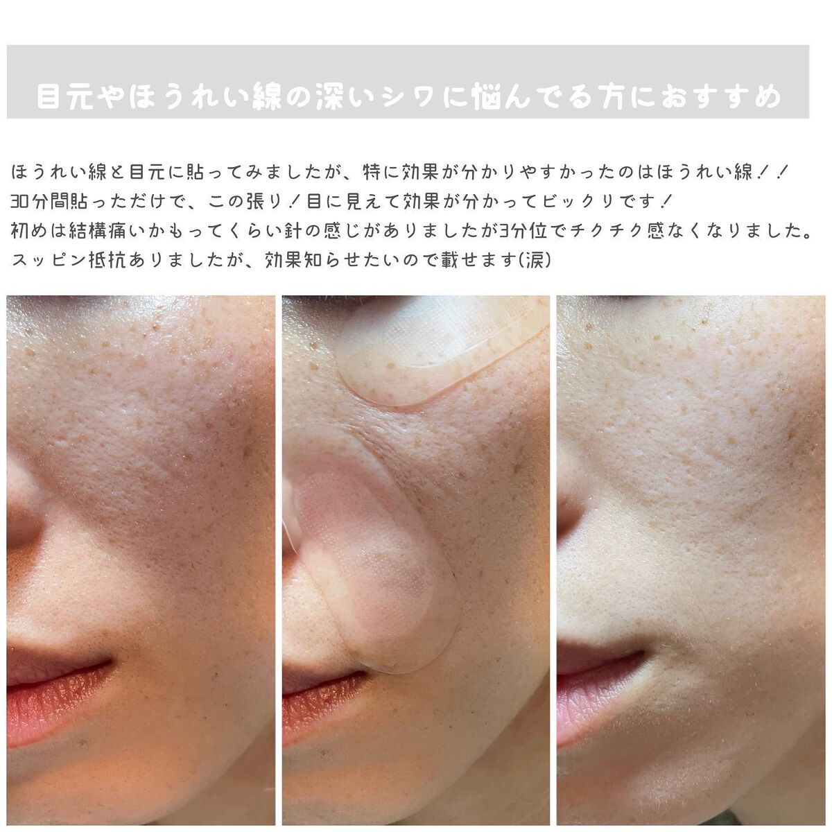 ゴールドコラーゲンニードルパッチ/SNP/アイケア・アイクリームを使ったクチコミ（3枚目）