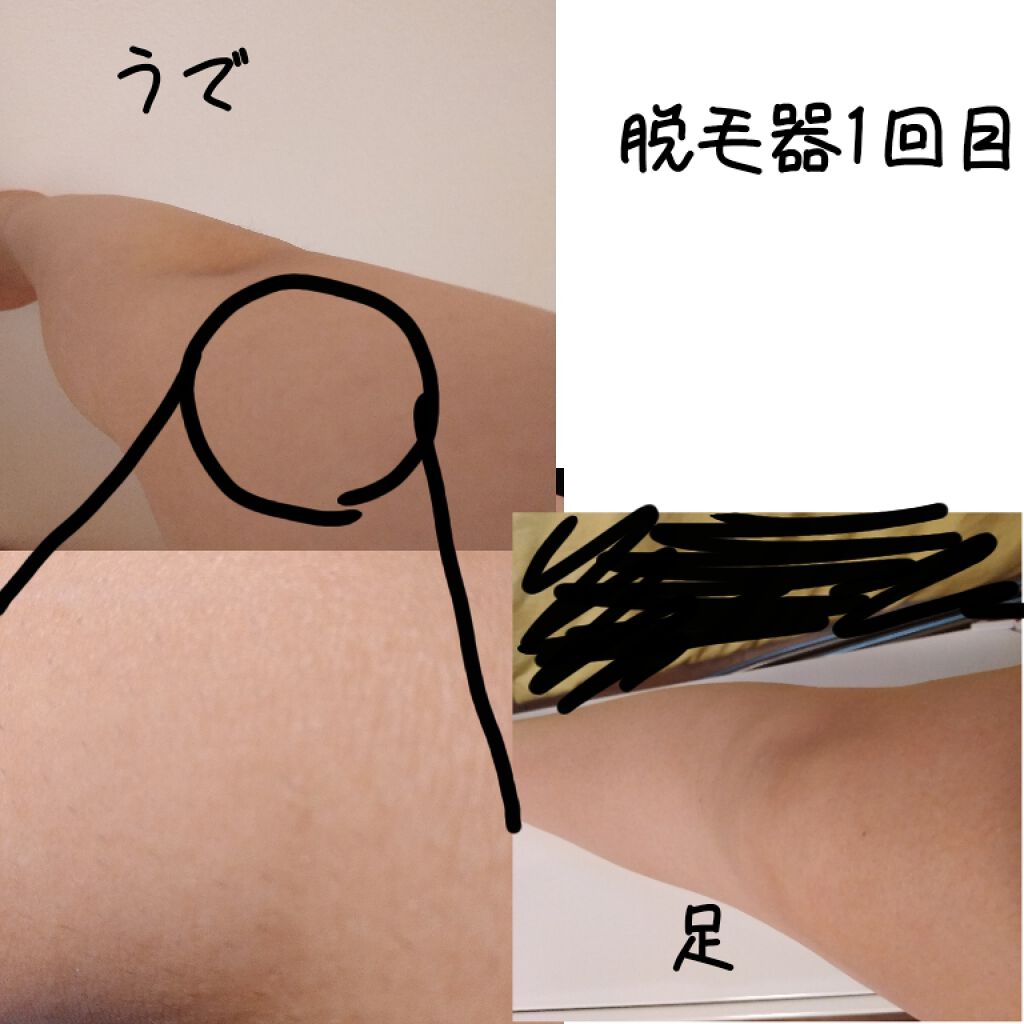 FASIZ607C IPL光脱毛器/FASIZ/家庭用脱毛器を使ったクチコミ(4枚目)