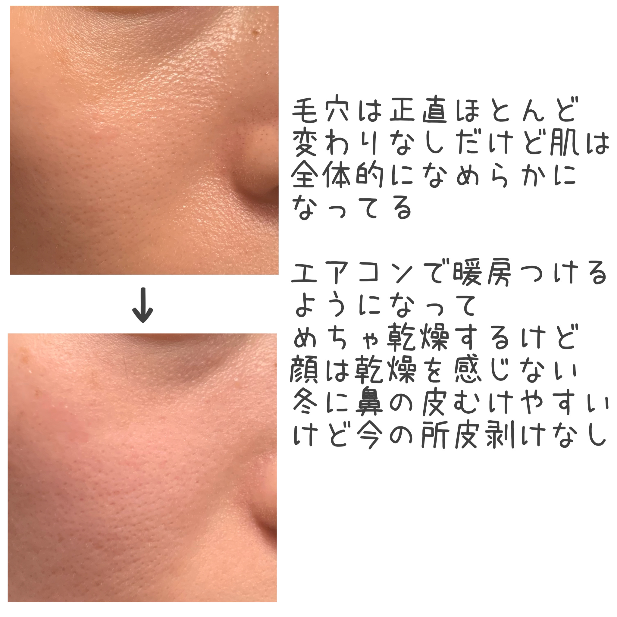 リードルショット リフティングセラム/VT/美容液を使ったクチコミ（2枚目）