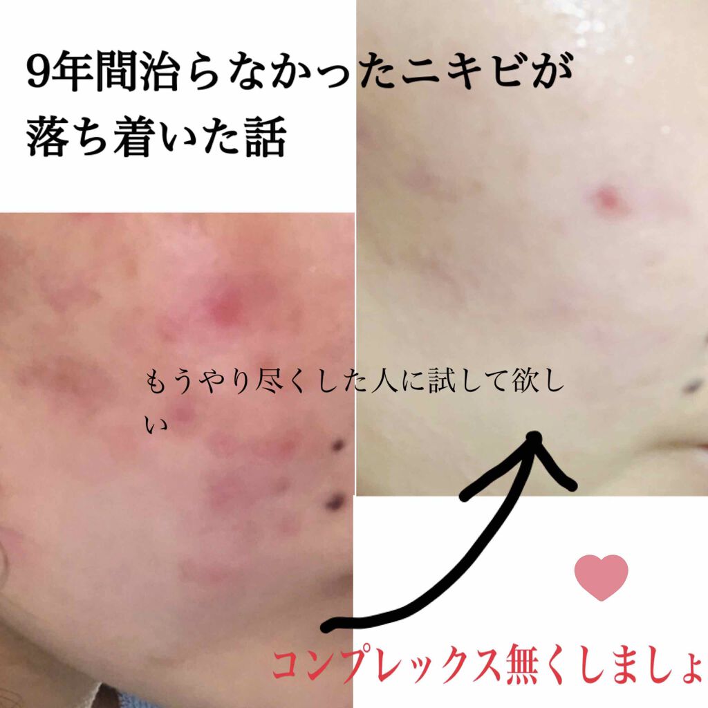 ロゼット洗顔パスタ アクネクリア/ロゼット/洗顔フォームを使ったクチコミ(1枚目)