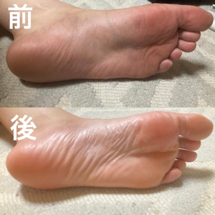 イージーパックDP60分タイプ/ベビーフット/レッグ・フットケアを使ったクチコミ(6枚目)