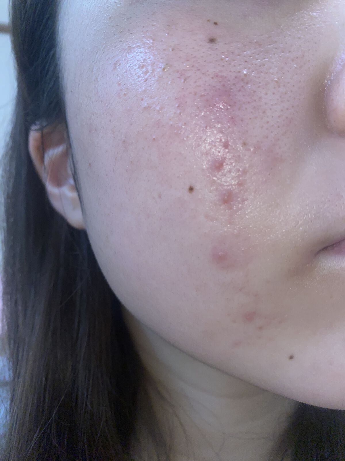 アクアチム軟膏1%/大塚製薬/その他スキンケアを使ったクチコミ（2枚目）