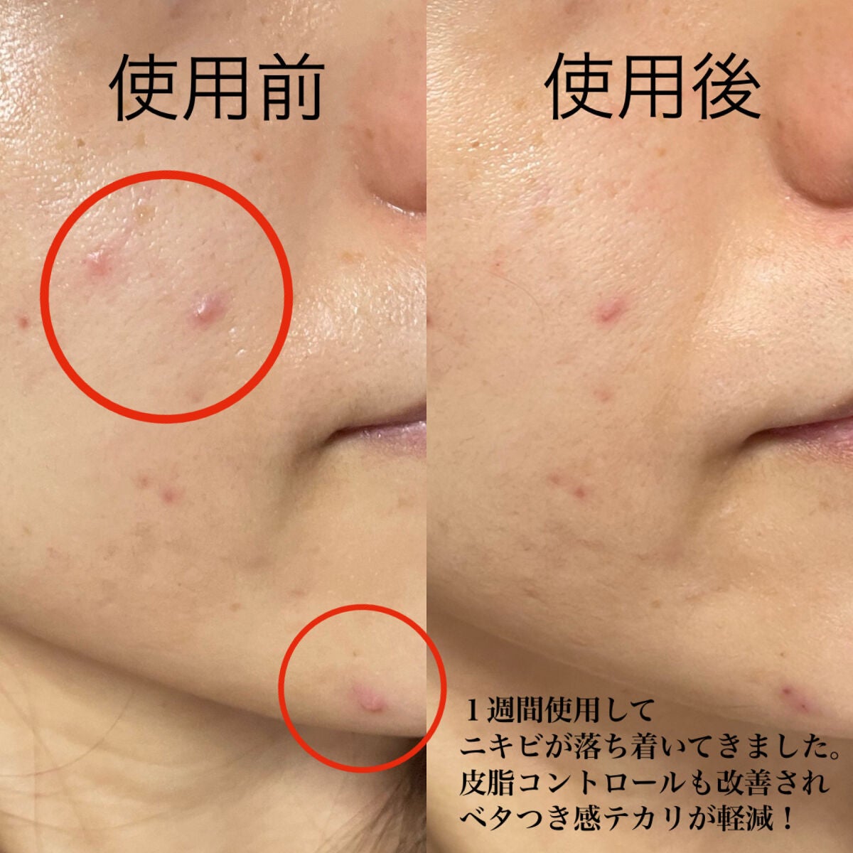 ACジェルクレンジング/NIKI PITA/クレンジングジェルを使ったクチコミ(9枚目)