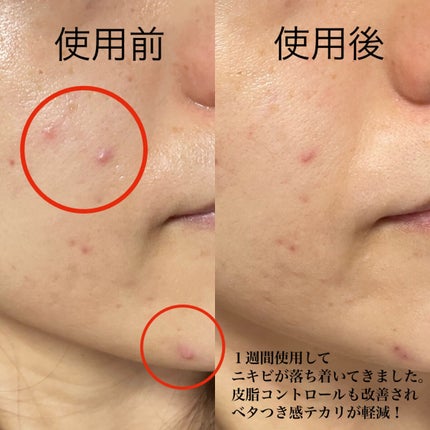 ACジェルクレンジング/NIKI PITA/クレンジングジェルを使ったクチコミ(9枚目)