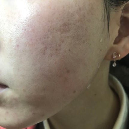 The Ordinary Amino Acid+B5のクチコミ「4/4🌱#汚肌工事録
\いつも閲覧ありがとう😭/
ちょうしがいい、、、!
あと毛穴.....」(2枚目)