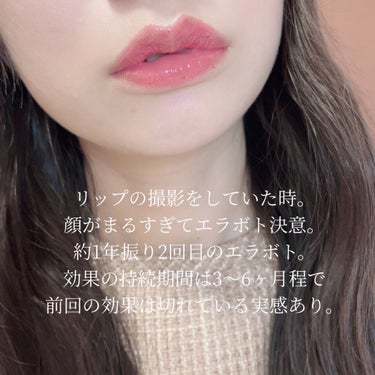 ぴーちゃん🧡 on LIPS 「1ヶ月経過報告～👏約1年振り2回目のエラボトックス。普通に肉眼..」（5枚目）