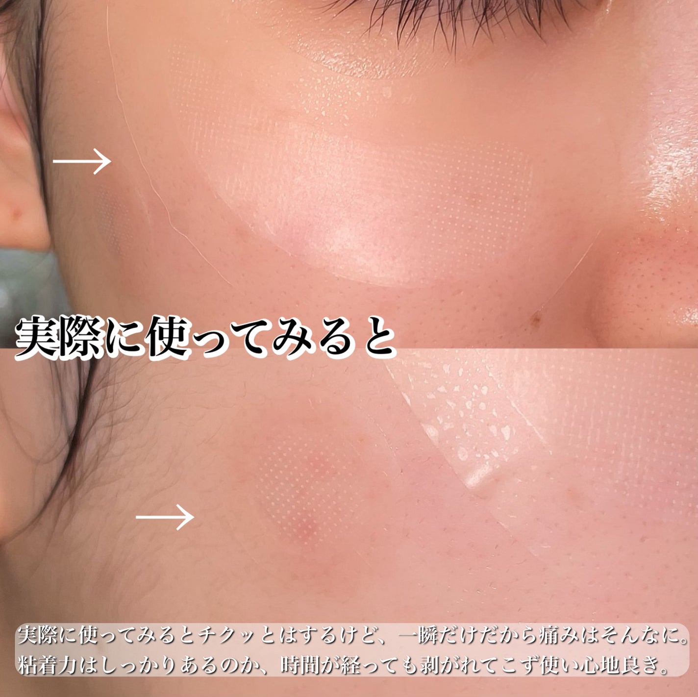 マイクロニードルパッチ シカ/MANYMU/シートマスク・パックを使ったクチコミ(6枚目)