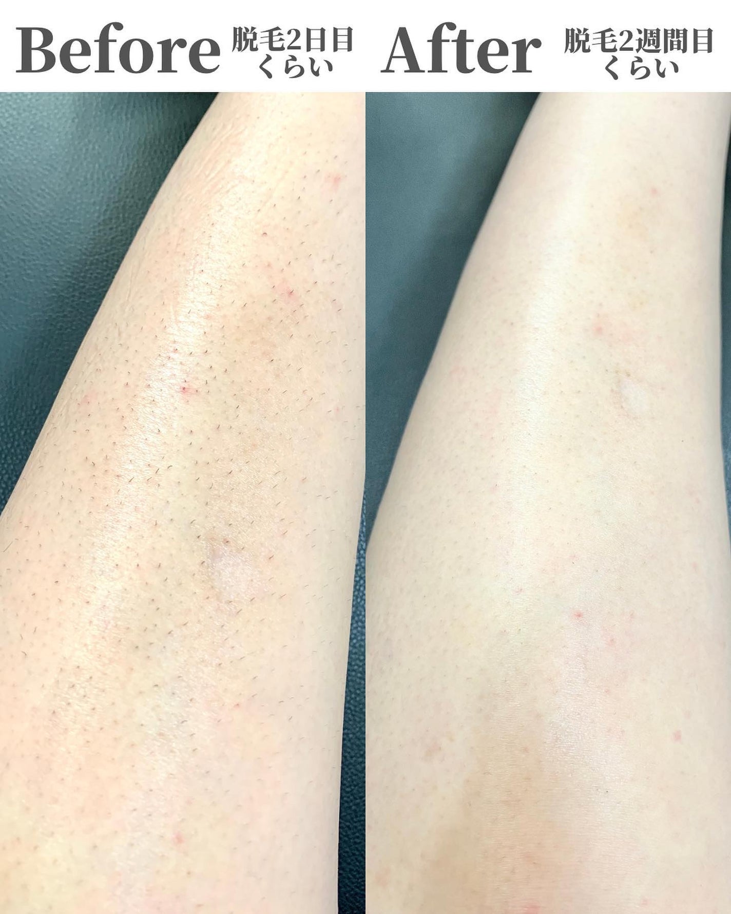 ããðÙèåãšéãð¥çŸå®¹ããã¢Ùð on LIPS ãâä»ã®æçš¿ãèŠãŠã¿ãã#alpakaãðâððDPLå
šèº«è±æ¯ã..ãïŒ5æç®ïŒ