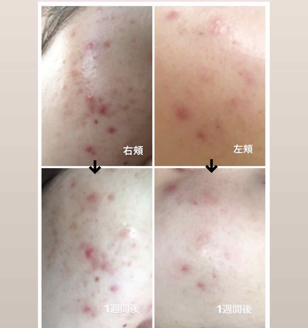 ノブ A アクネソープ/NOV/洗顔石鹸を使ったクチコミ(2枚目)