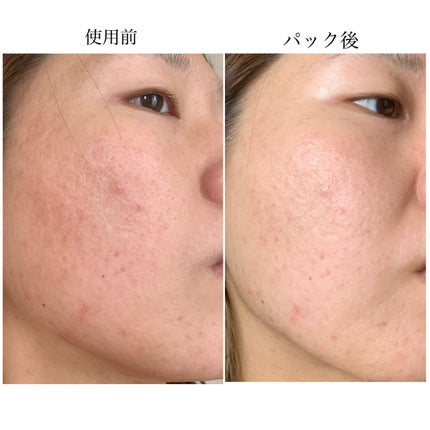 ドクダミトナーデイリーシートマスク/Anua/シートマスク・パックを使ったクチコミ(6枚目)