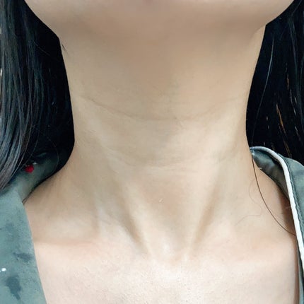 リンクルフィットマスク+ニードルローラー/MEDITHERAPY/美顔器・マッサージを使ったクチコミ(6枚目)