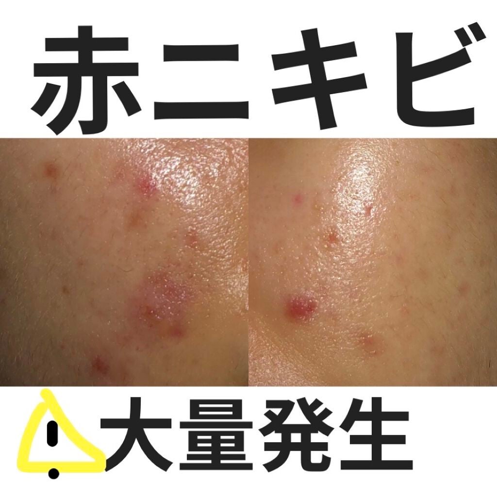 ペアアクネクリームW(医薬品)/ペア/その他を使ったクチコミ(1枚目)