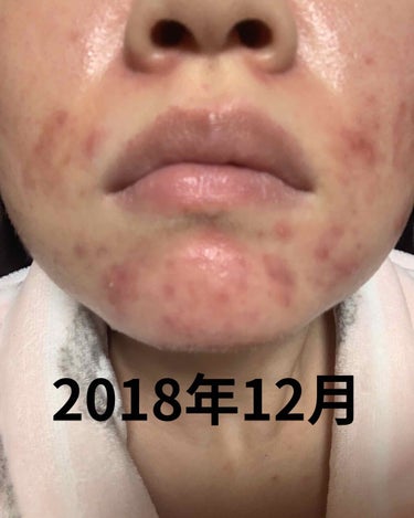 にゃも on LIPS 「初めまして🙋‍♀️✨最近肌の調子が良くなり、悩んでたのが嘘みた..」（2枚目）