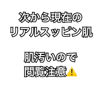 たそ on LIPS 「⚠️閲覧注意⚠️流行りのダーマペン4を施術しに行きます！（とい..」（2枚目）