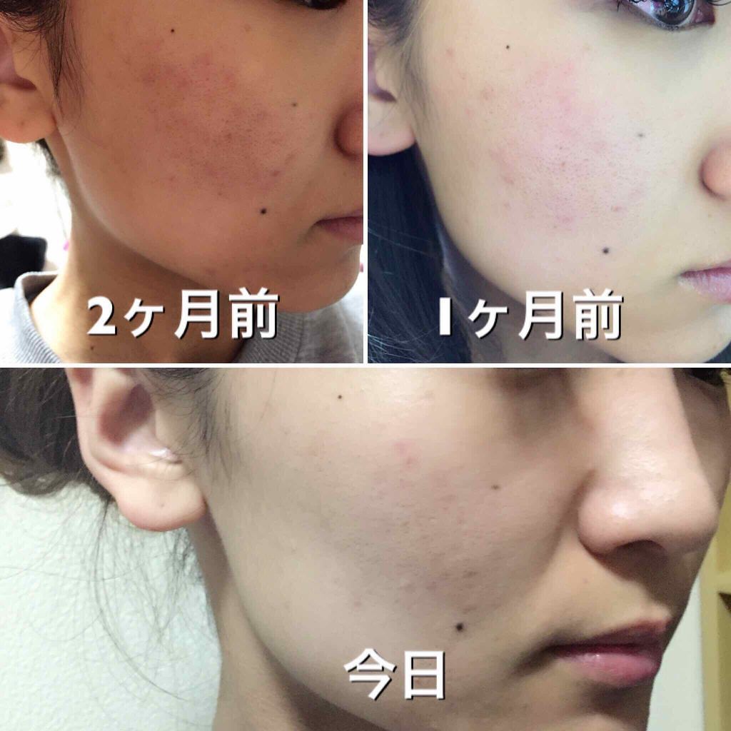 薬用 しみ 集中対策 美容液/メラノCC/美容液を使ったクチコミ（3枚目）