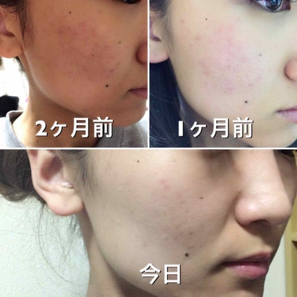 薬用 しみ 集中対策 美容液/メラノCC/美容液を使ったクチコミ(3枚目)