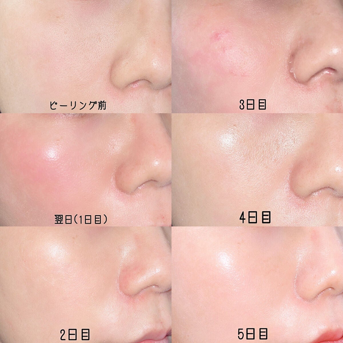 ダーマスキンピーリング/BQCELL/その他キットセットを使ったクチコミ(4枚目)