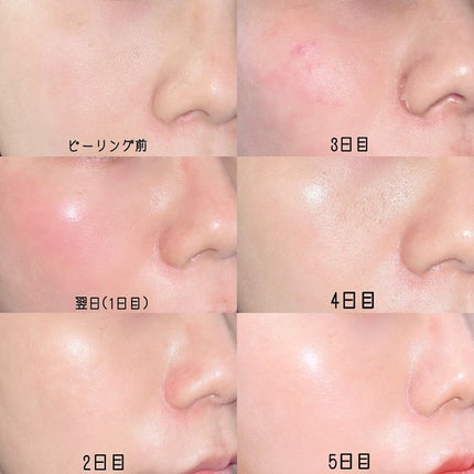 ダーマスキンピーリング/BQCELL/その他キットセットを使ったクチコミ(4枚目)