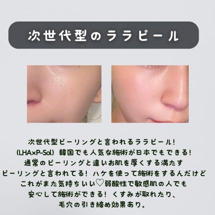 秋瀬ルナ.美容サプリ/韓国コスメ🇰🇷 on LIPS 「最近行った施術(ピーリング系)をまとめてみた!🔹剥離ありハーブ..」(4枚目)