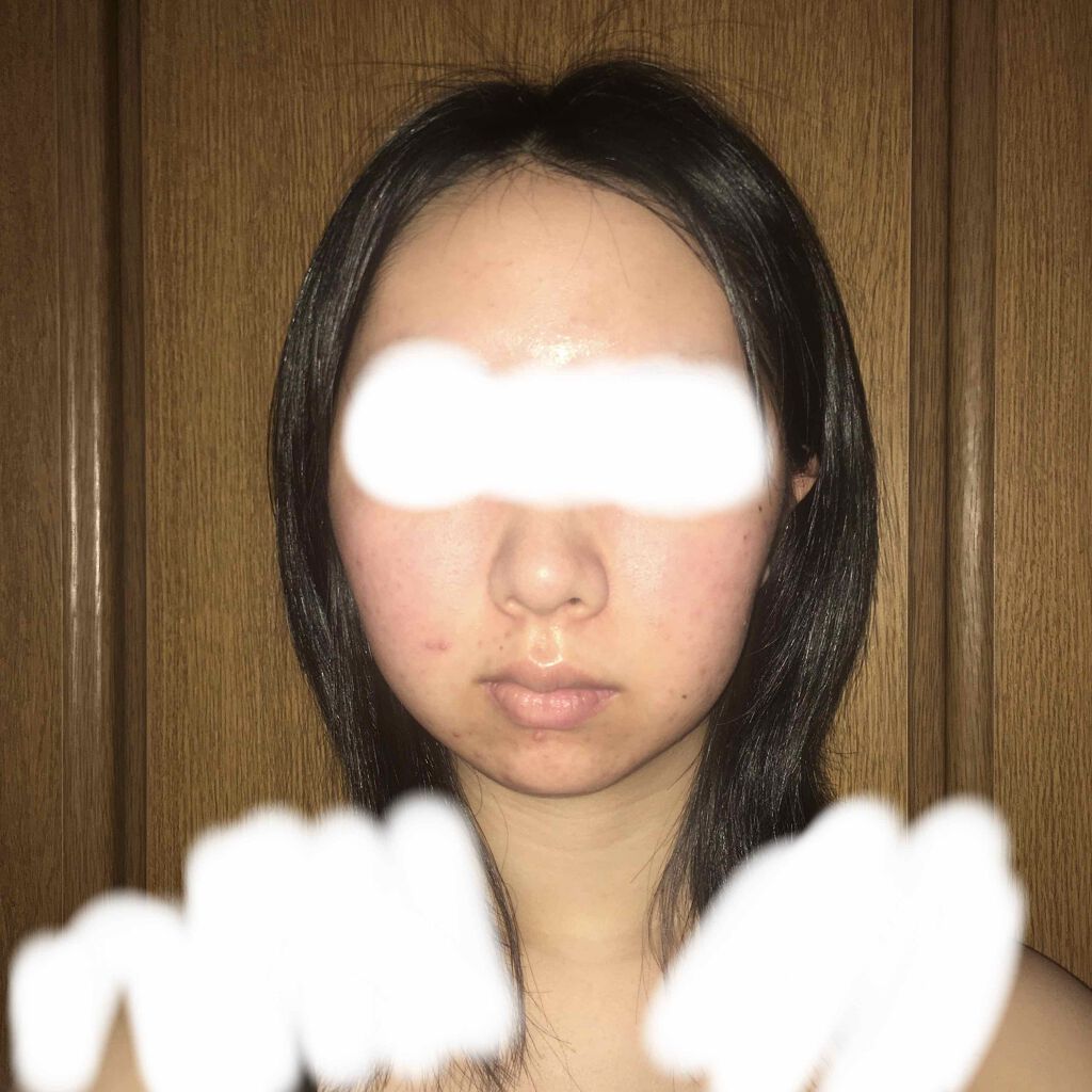フワフワネコチャン on LIPS 「塗り始めて9日目(10日目朝)の写真です!今日はカメラが汚れて..」(4枚目)