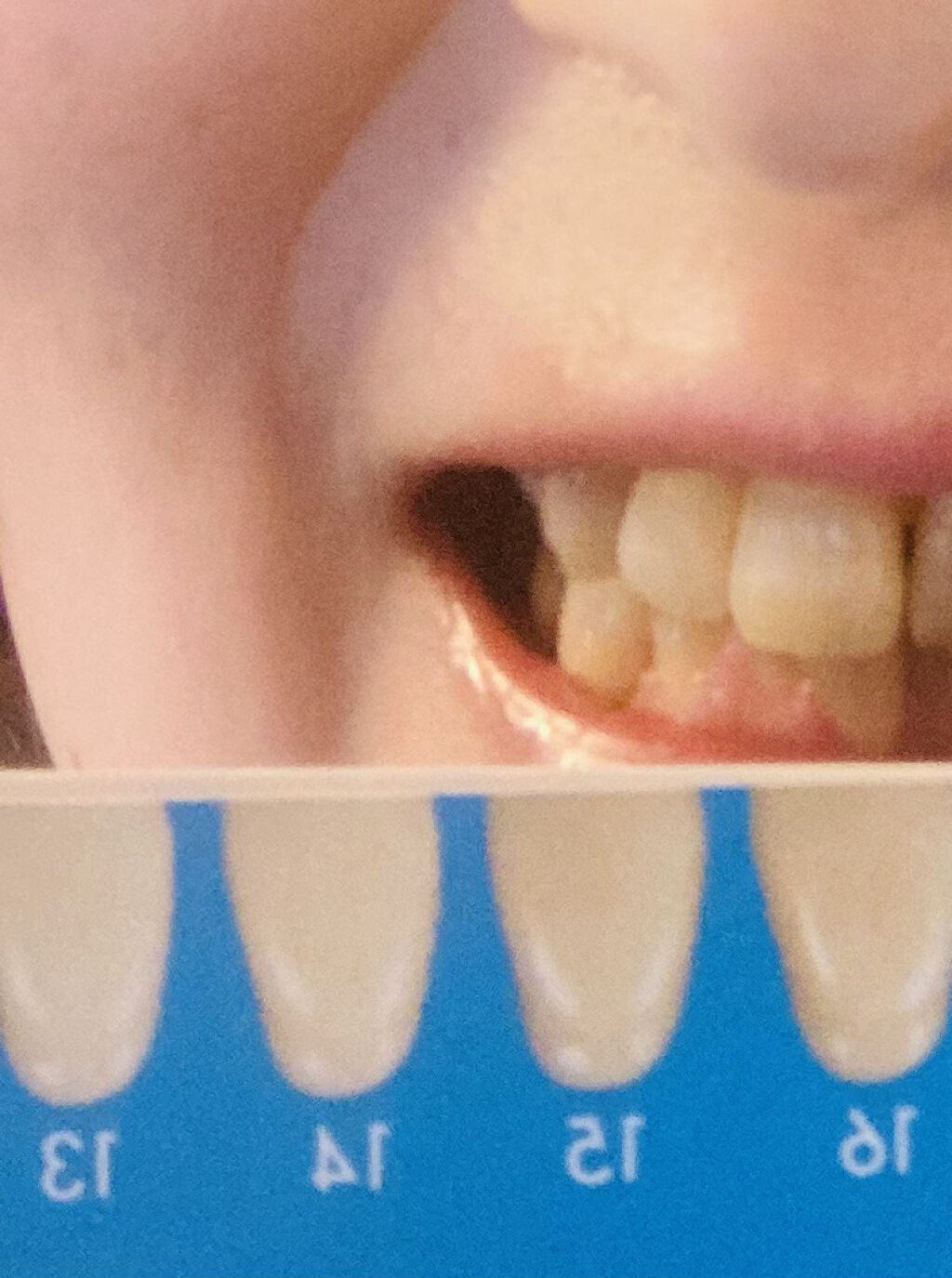 Dr.USB ホワイトニング専用LEDライト/WHITE CLUB/その他オーラルケアを使ったクチコミ（3枚目）