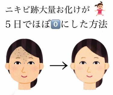 ニキビ跡   抹殺法😇


ニキビ跡…
いつまで経っても消えてくれなかった😭
りんかの場合、おでこのニキビ跡が
ぼぼぼぼぼって大量に出来てた！
「これ、ニキビ跡無くなる！」
っておすすめされたのもりんか