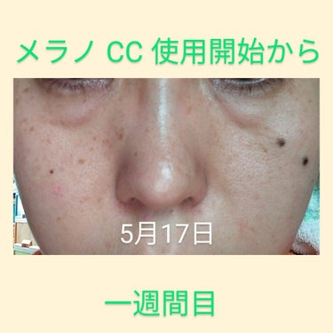 伊菜夏(いなか) ※ 体調不良でお休み中 on LIPS 「こんにちわ😊メラノCCを使い初めてから2週間経過です。・黒ずみ..」（2枚目）