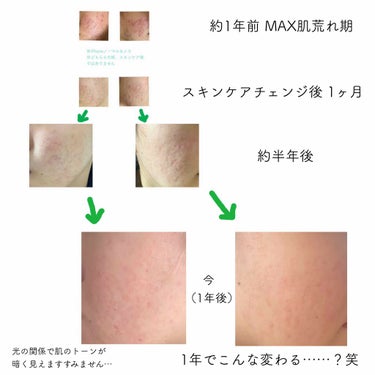 innisfree ビジャ シカバーム EXのクチコミ「現在ニキビ、ニキビ跡に悩むそこの乙女…これを見て元気を出すんだ…!!!

#スキンケア #肌荒.....」（2枚目）