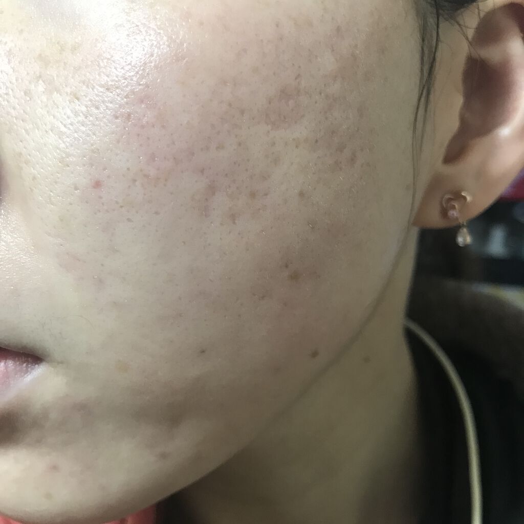 LA10+HAフェイスセラム/The Ordinary/ピーリングを使ったクチコミ（2枚目）