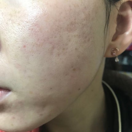 LA10+HAフェイスセラム/The Ordinary/ピーリングを使ったクチコミ(2枚目)