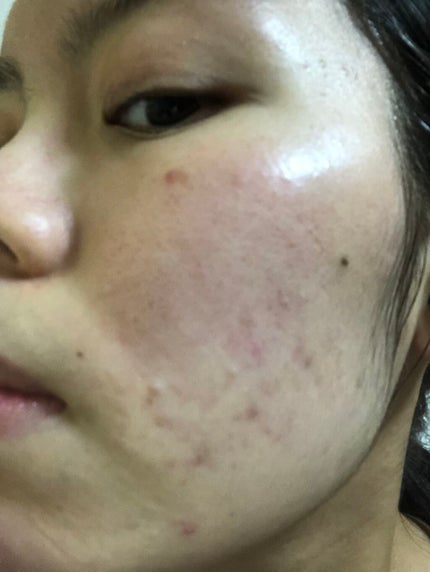楓@LIPSパートナー on LIPS 「#ニキビスキンケア初投稿です。いきなり黒歴史を公開いたします笑..」(6枚目)