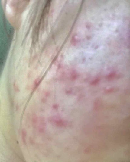 薬用 しみ 集中対策 美容液/メラノCC/美容液を使ったクチコミ(2枚目)