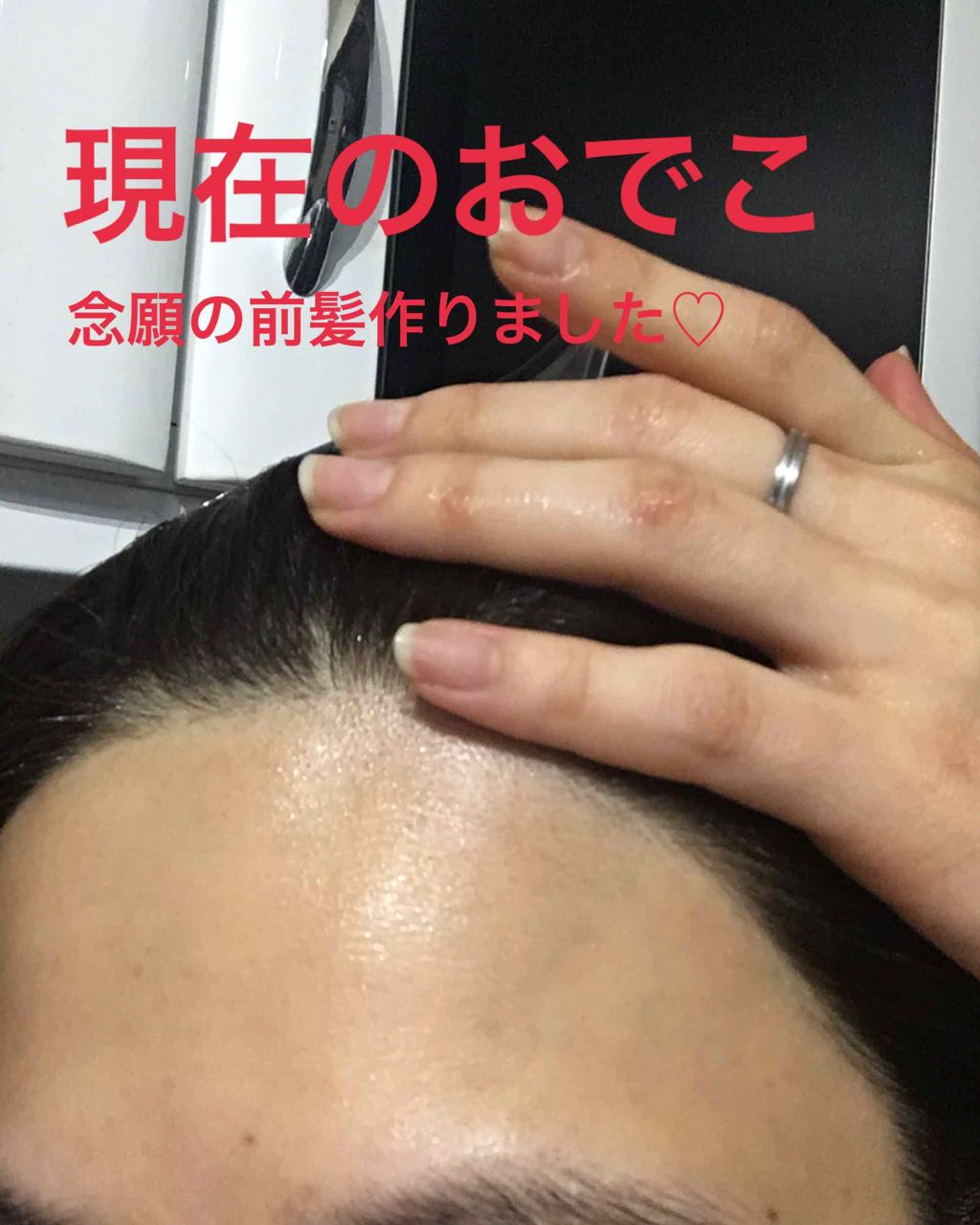 家庭用脱毛器 ケノン Ke Non エムテックの口コミ 私富士額で 年以上前髪を作ったことがあ By なっちゃん 乾燥肌 30代後半 Lips