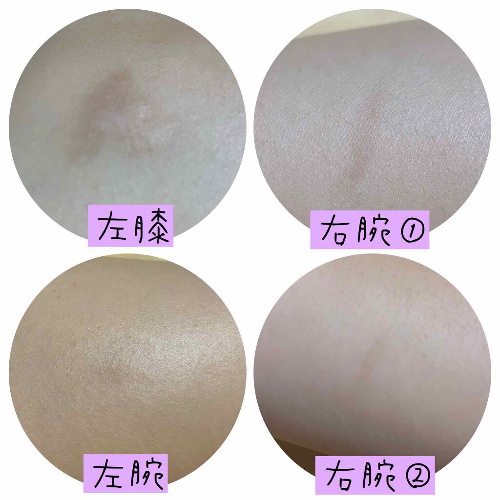 バイオイル/バイオイル/フェイスオイルを使ったクチコミ（2枚目）