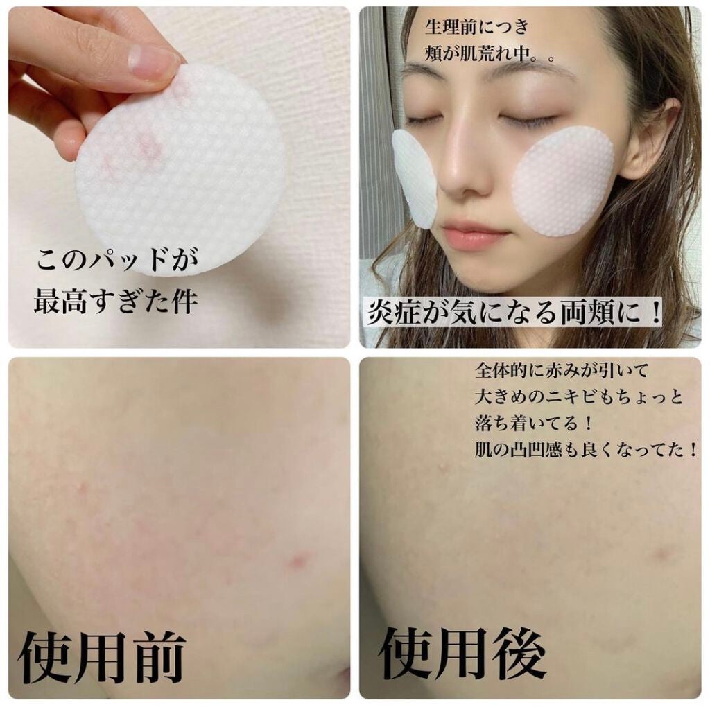 ドクダミ77%クリアパッド/Anua/トナーパッドを使ったクチコミ(3枚目)