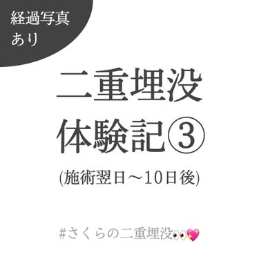 さくら🌸 on LIPS 「二重埋没体験記③👀💖(施術翌日〜10日後)----------..」（1枚目）