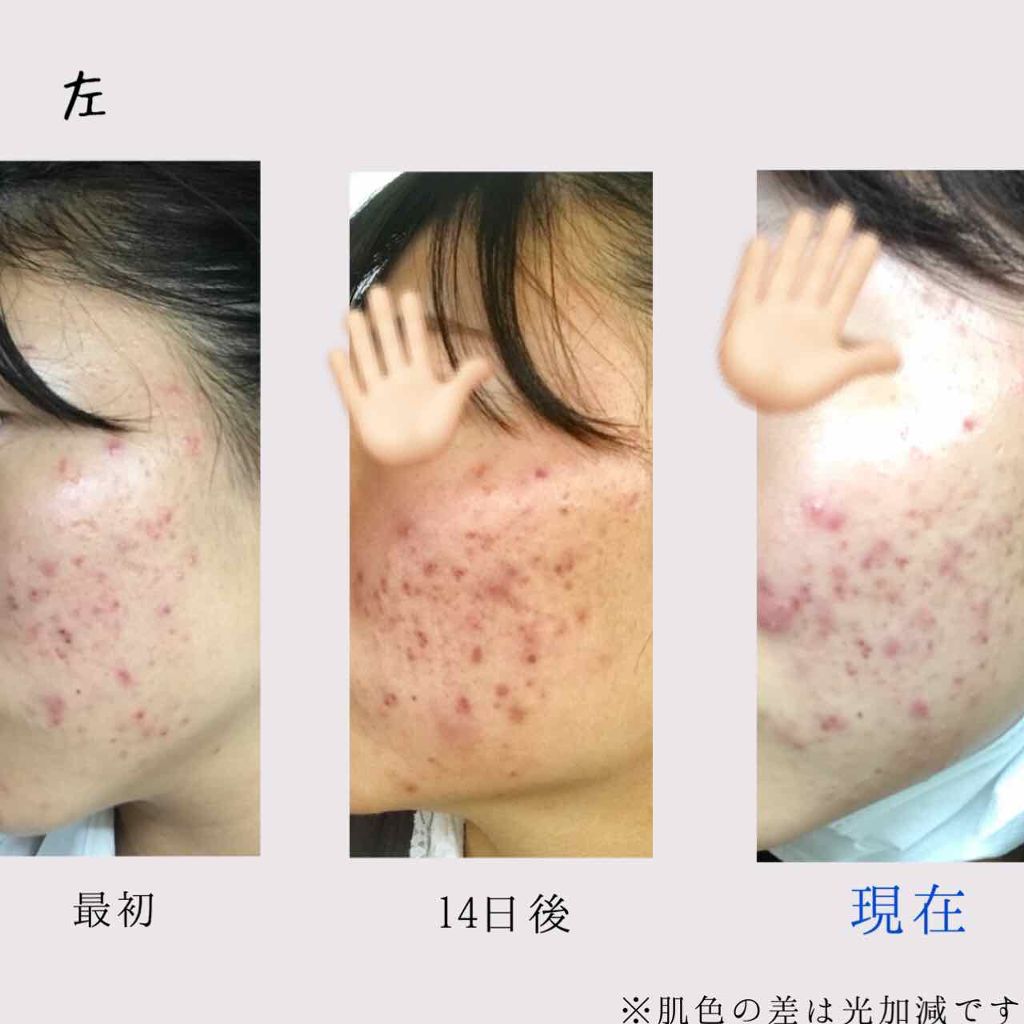 ハトムギ化粧水(ナチュリエ スキンコンディショナー R )/ナチュリエ/化粧水を使ったクチコミ(2枚目)